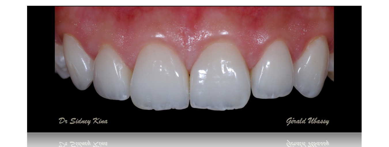 12 Veneers, Kina /Ubassy